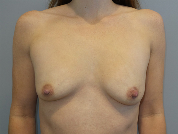 Mini Breast Lift Before and After 18 | Sanjay Grover MD FACS