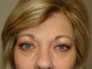 Blepharoplasty Before and After 04 | Sanjay Grover MD FACS