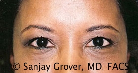 Blepharoplasty Before and After 29 | Sanjay Grover MD FACS