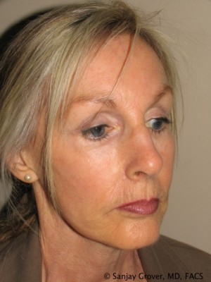 Facelift Before and After 08 | Sanjay Grover MD FACS
