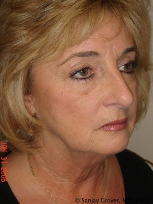 Facelift Before and After 03 | Sanjay Grover MD FACS