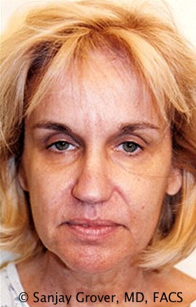 Facelift Before and After 32 | Sanjay Grover MD FACS