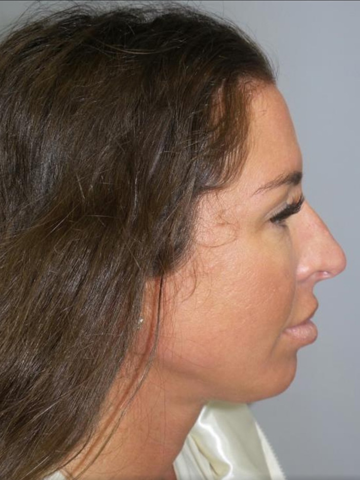 Rhinoplasty Before and After 09 | Sanjay Grover MD FACS