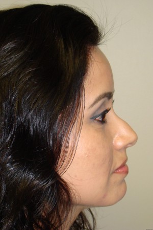 Rhinoplasty Before and After 13 | Sanjay Grover MD FACS