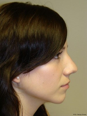 Rhinoplasty Before and After 31 | Sanjay Grover MD FACS