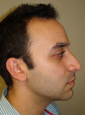 Rhinoplasty Before and After 40 | Sanjay Grover MD FACS