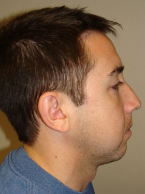 Rhinoplasty Before and After 11 | Sanjay Grover MD FACS
