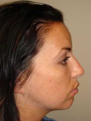 Rhinoplasty Before and After 17 | Sanjay Grover MD FACS