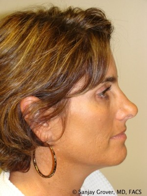 Rhinoplasty Before and After 10 | Sanjay Grover MD FACS