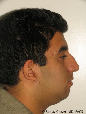 Rhinoplasty Before and After 16 | Sanjay Grover MD FACS