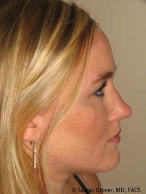 Rhinoplasty Before and After 06 | Sanjay Grover MD FACS