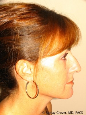 Rhinoplasty Before and After 48 | Sanjay Grover MD FACS