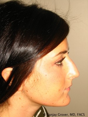 Rhinoplasty Before and After 30 | Sanjay Grover MD FACS