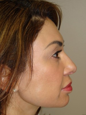 Rhinoplasty Before and After 43 | Sanjay Grover MD FACS