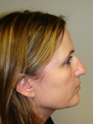 Rhinoplasty Before and After 36 | Sanjay Grover MD FACS