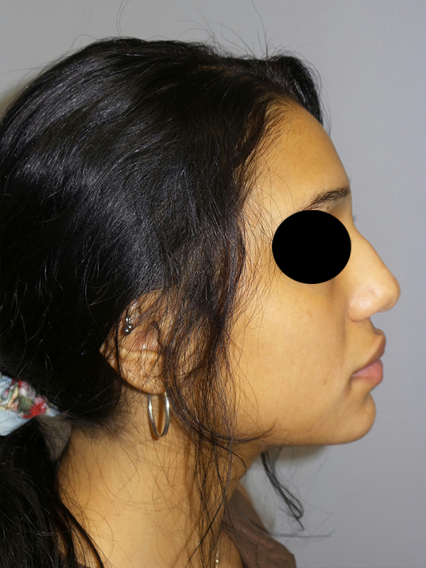 Rhinoplasty Before and After 11 | Sanjay Grover MD FACS