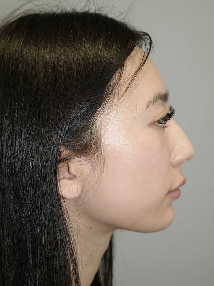 Rhinoplasty Before and After 01 | Sanjay Grover MD FACS