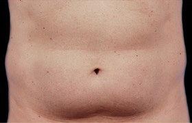 Coolsculpting Before and After 03 | Sanjay Grover MD FACS