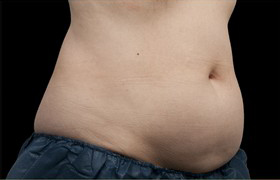 Coolsculpting Before and After 16 | Sanjay Grover MD FACS